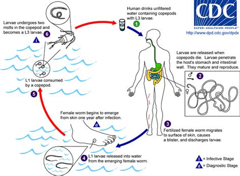 Dracunculiasis - wikidoc