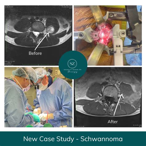 Case Study: Schwannoma | Dr. Salvatore Zavarella, DO, FACOS