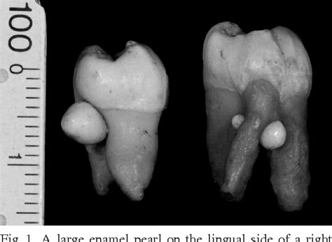 Figure 1 from Prevalence of enamel pearls in teeth from a human teeth ...