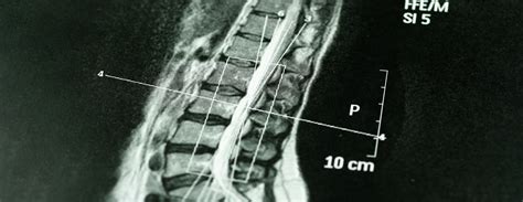 Thoracic spine CT scan