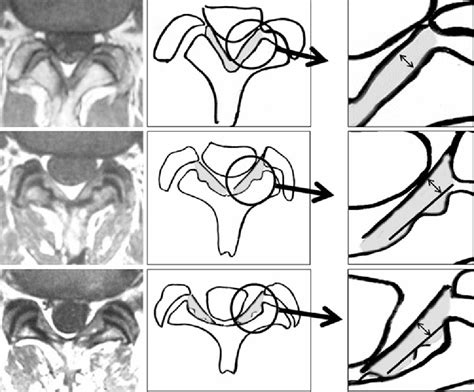 Measurements of ligamentum flavum thickening at lumbar spine using MRI | Semantic Scholar