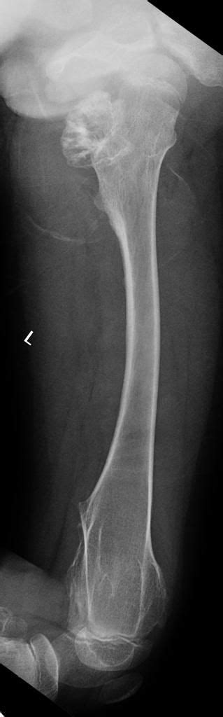 Hereditary multiple exostoses | Radiology Case | Radiopaedia.org | Radiology, Hereditary, Multiple