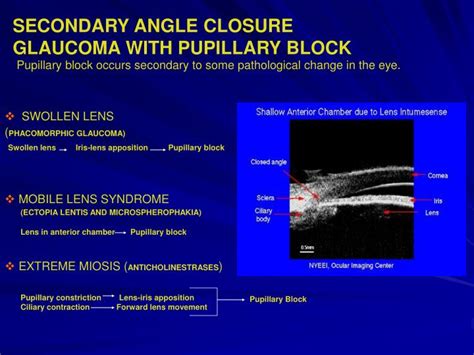 PPT - ANGLE-CLOSURE GLAUCOMA PowerPoint Presentation - ID:6217582