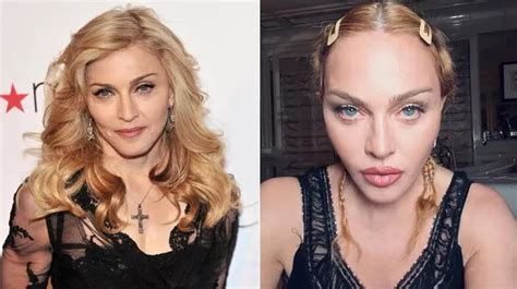 Pop Icon Madonna Plastic Surgery Before and After