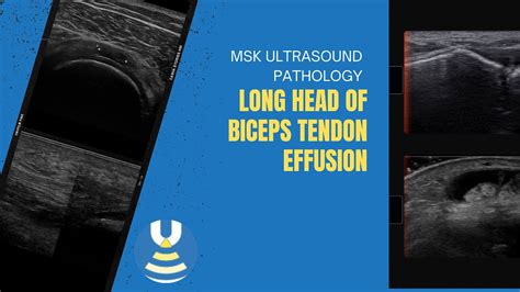 Distal Biceps Tendon Ultrasound