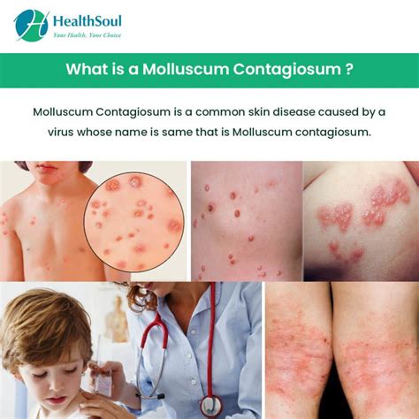 Molluscum Contagiosum - Community Health Systems of Wisconsin