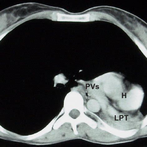 (PDF) Unilateral pulmonary hypoplasia