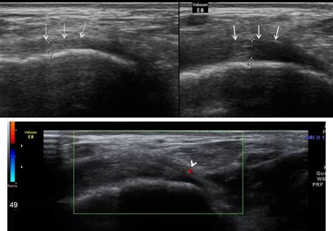 Gluteus Medius Tendon Ultrasound