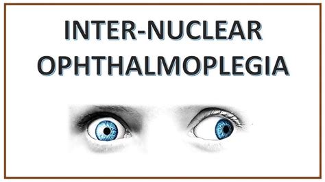 Internuclear Ophthalmoplegia - Neuropedia