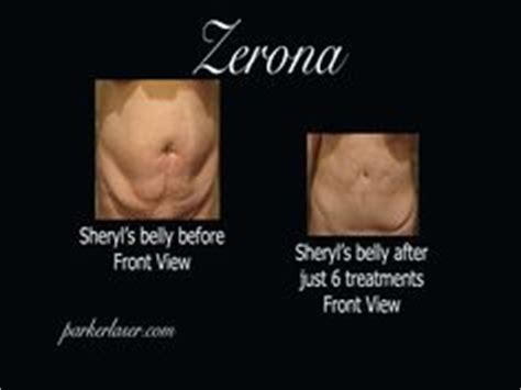 1000+ images about Zerona Before and After on Pinterest | Laser removal ...