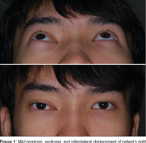 Figure 1 from Giant craniofacial osteoma with orbital invasion ...