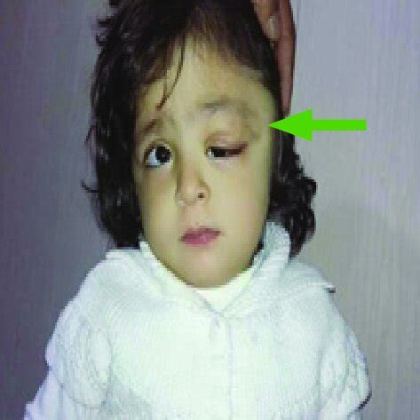 periorbital dermoid cyst in a toddler patient presented with a drooping... | Download Scientific ...