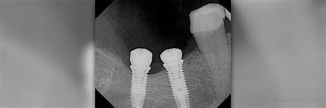 Dental implants failure symptoms | General center | SteadyHealth.com