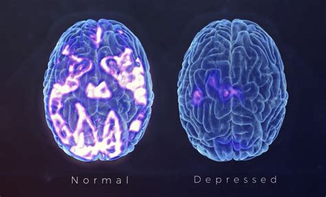 brain scans - AltaPointe Health