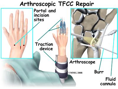 Triangular Fibrocartilage Complex (TFCC) Tears Wrist Conditions Treatments Dallas Texas