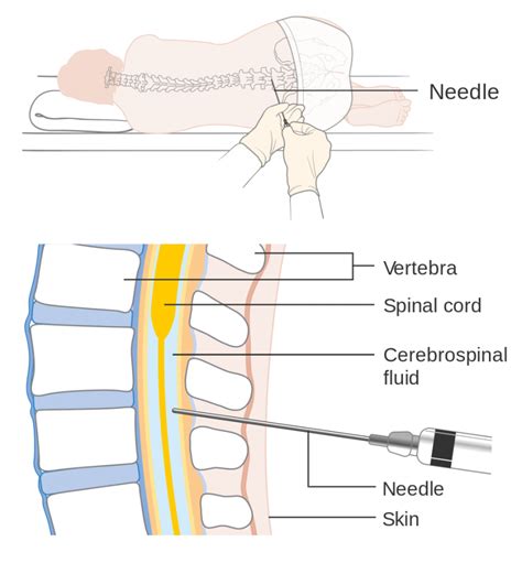 Spinal tap – Healthy.net