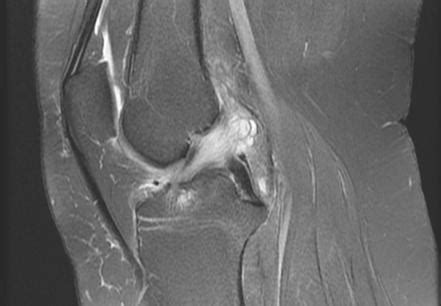 mucoid degeneration of acl treatment - geraldroegner-99