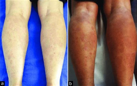 Skin recovery after febuxostat withdrawal (a); fl are-up after drug... | Download Scientific Diagram