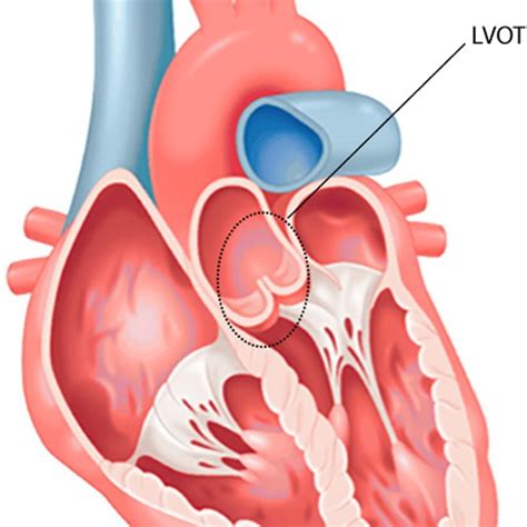 One PVC acquired during the catheter ablation procedure when OT-VA ...