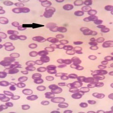 Peripheral blood smear shows giant platelets (black arrow) surrounded ...