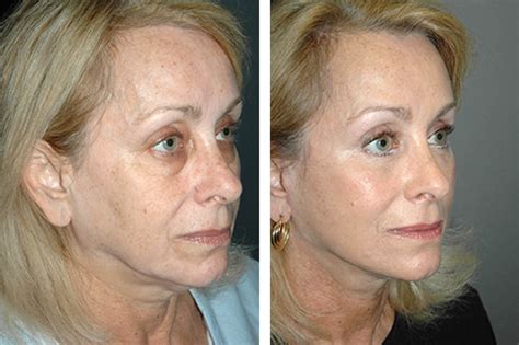 SMAS Facelift | Best SMAS Facelift Surgeon | SMAS Face Lift