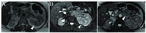 Transitional cell carcinoma. Transitional cell carcinoma. (A,B ...