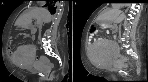 A Case of Lethal Abdominal Compartment Syndrome due to Rapidly ...