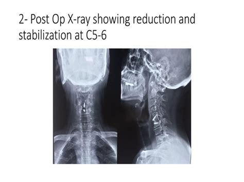 Anterior Cervical Discectomy and Fusion ACDF for Facet Subluxation C5-6 – Best Spine Surgeon in ...