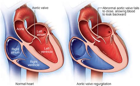 Aortic Valve Regurgitation - Causes, Symptoms, Treatment