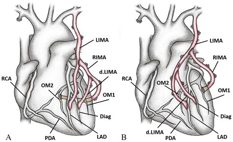 The π-Circuit Technique in Coronary Surgery: Analysis of 1359 Consecutive Cases - Sotirios N ...