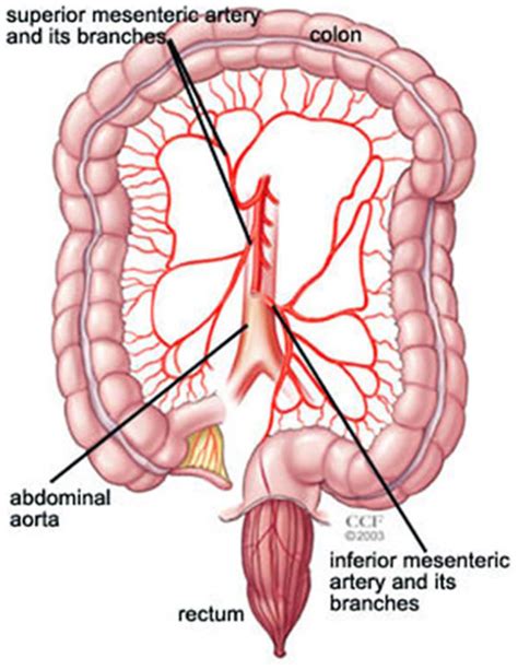 Mesenteric artery stenosis - G Jay Bishop, Sean P Lyden, Elizabeth V ...