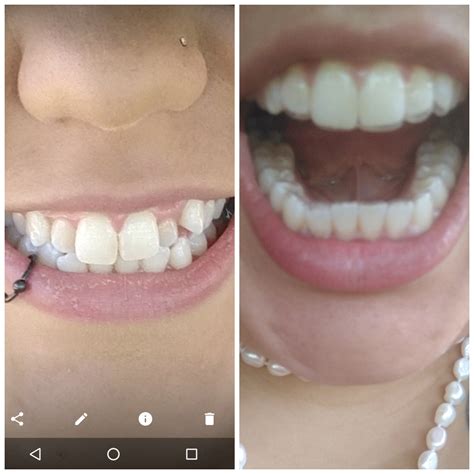 My Smile Direct Club Aligners Don T Fit - FitnessRetro