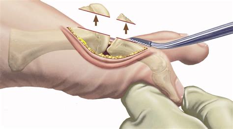 Big Toe Joint Conditions - Ottawa Foot Clinic