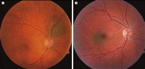 Visual Acuity in 3422 Consecutive Eyes With Choroidal Nevus | Dermatology | JAMA Ophthalmology ...