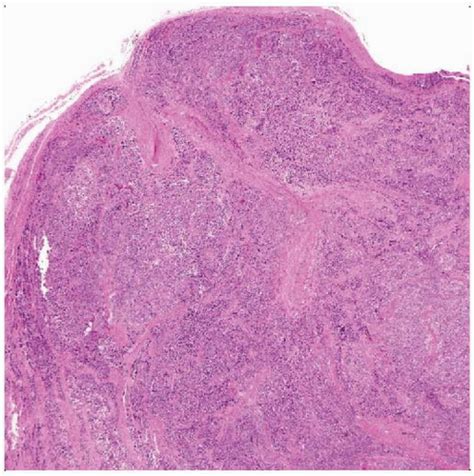 Clear Cell Sarcoma | Basicmedical Key