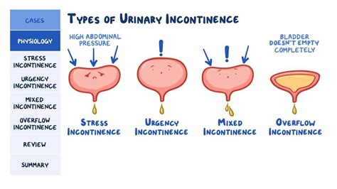 Urinary incontinence: Pathology review: Video | Osmosis