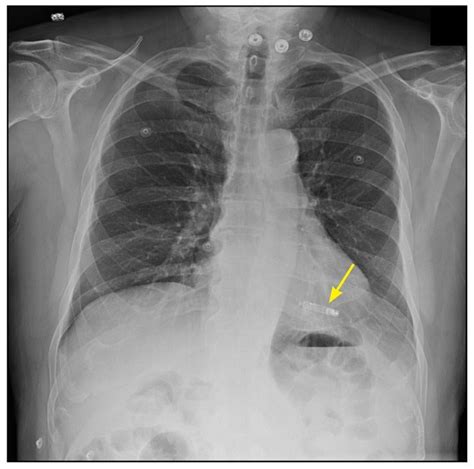 PSA for MRI techs. To me, this Medtronic Micra pacemaker looks like a ...