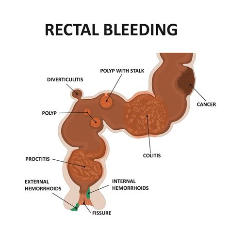 Rectal Bleeding And Bleeding From The Rectum Causes And Diagnosis | The ...