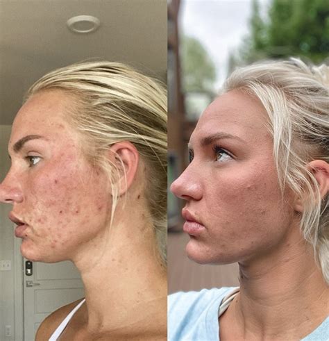 My Experience on Accutane | mikzazon.com