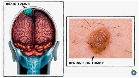 Benign - Definition and Examples - Biology Online Dictionary