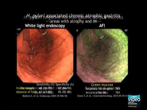 H Pylori Endoscopy Findings