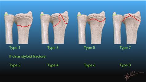 FRYKMAN CLASSIFICATION PDF