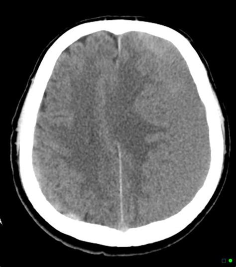 Subdural Hemorrhage CT Scan