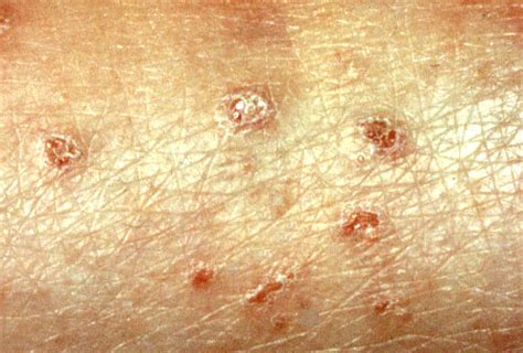 Dermatitis Herpetiformis - Pictures, Symptoms, Causes and Treatment