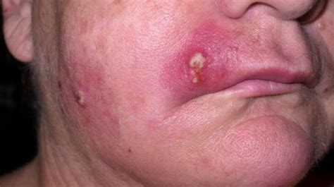 Staph Infection: Symptoms, Causes & Treatment | Staphylococcus aureus