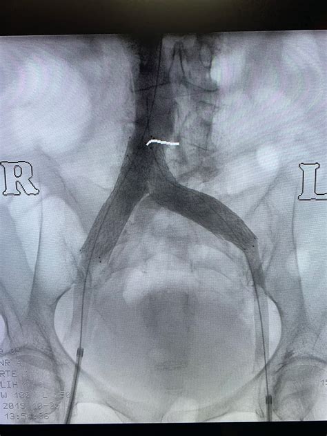 Venogram Venous Occlusive Disease