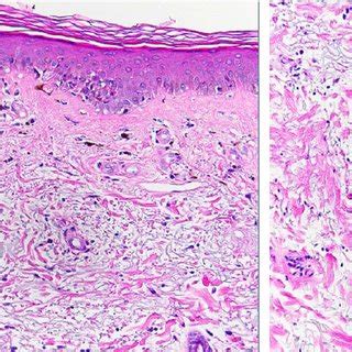 Biopsy demonstrates burned out lichenoid interface dermatitis with... | Download Scientific Diagram