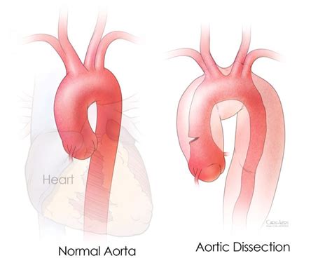 What is Aortic Disease? | McGovern Medical School