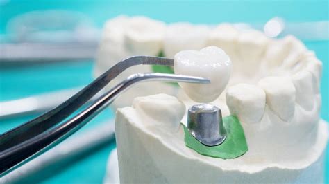 Dental Crown Benefits | Restore Your Smile