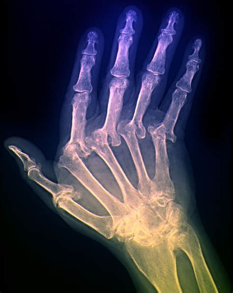 Ulnar Drift in Rheumatoid Arthritis